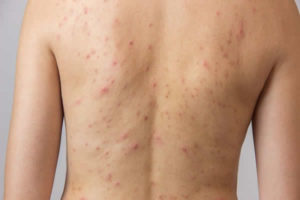 Como vencer acne corporal?
